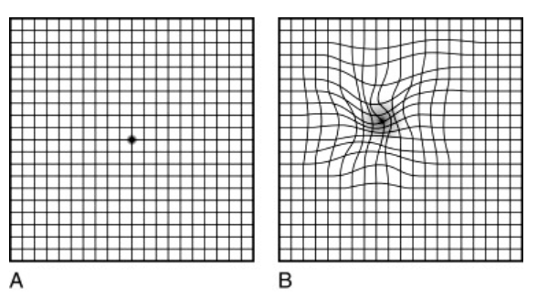 Amsler grid test